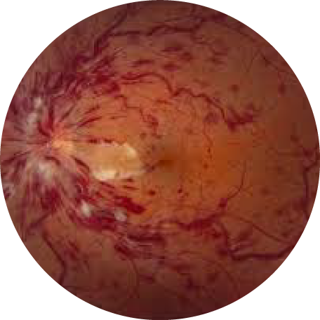 A OCT image of a retina with Retinal vein occlusions