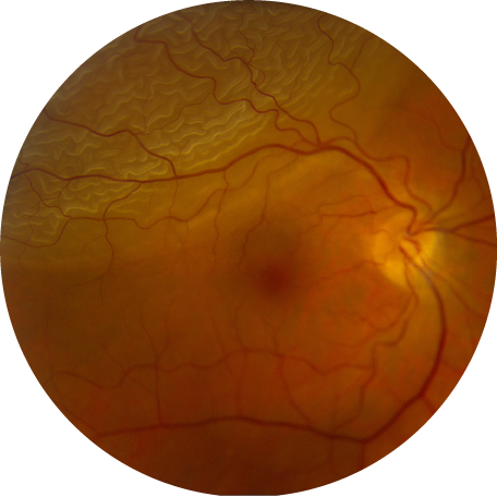 An OCT image of a retinal detachment