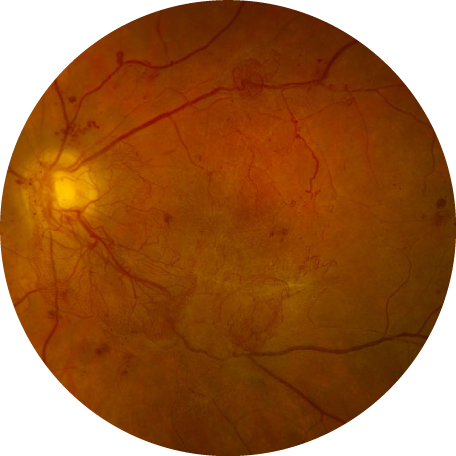 An OCT image of the retina, showing an eye with diabetic retinopathy
