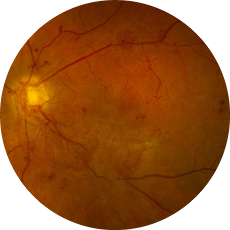 Retina Raleigh, Diabetic Retinopathy Raleigh