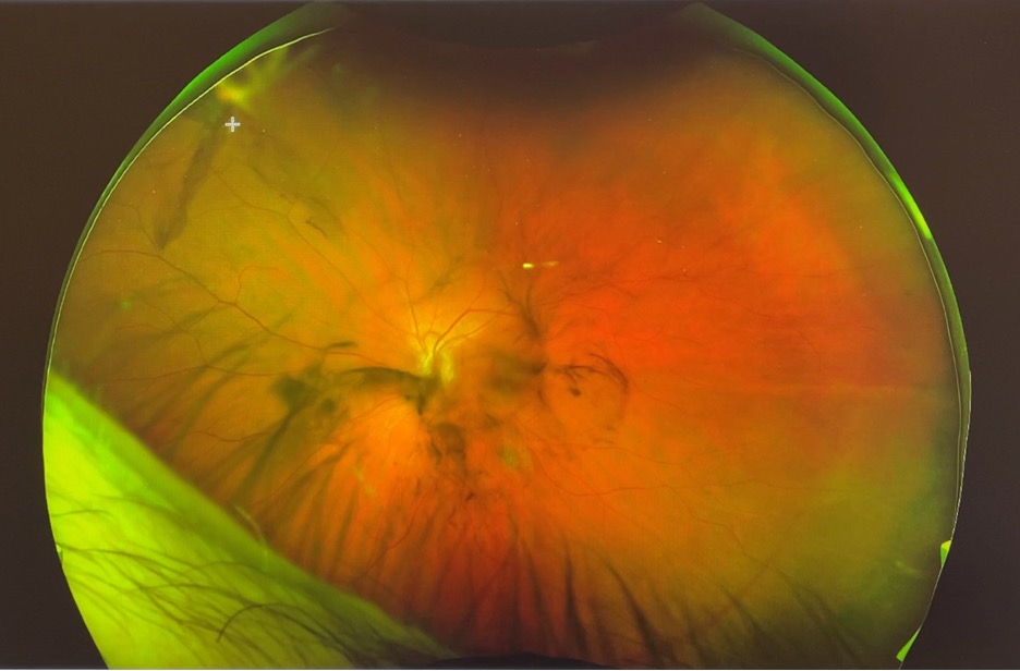 Retina photo demonstrating vitreous hemorrhage and superonasal retinal tear