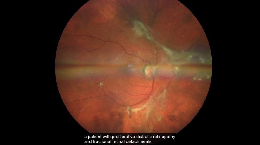 An image showing the retina of an eye affected by proliferative diabetic retinopathy, with abnormal blood vessels growing throughout the retina, extending from the optic nerve, and contributing to tractional retinal detachments. Scar tissue is visible, and the retina appears to be pulling away from the wall of the eye in localized areas.