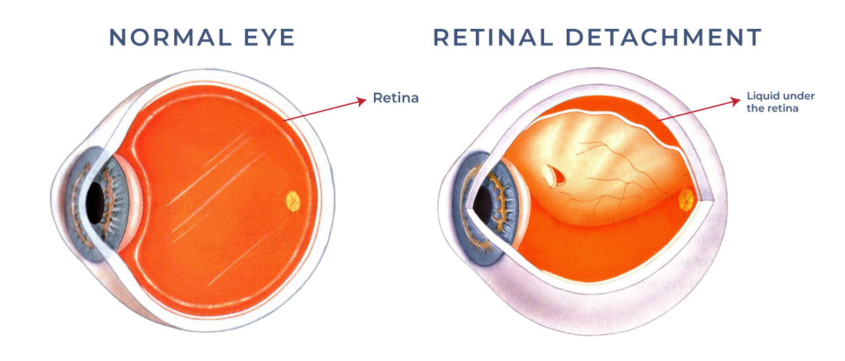 An illustration of a retinal detachment in a human eye. The retina appears detached and is pulling away from the underlying tissue.