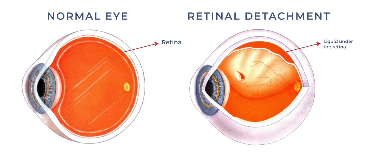 Retinal Detachment - Vitreo-Retinal Consultants