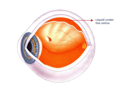 What are the symptoms of a retinal detachment?