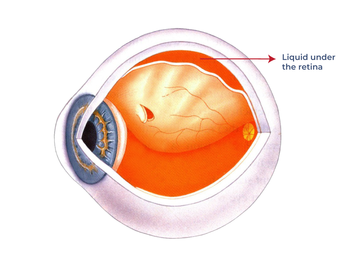 An illustration of a retinal detachment in a human eye. The retina appears detached and is pulling away from the underlying tissue.