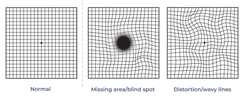 What Is An Example Of Abnormal Amsler Grid