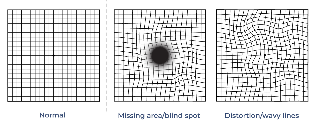 Examples of Amsler Grid with grid lines to test for vision abnormalities.