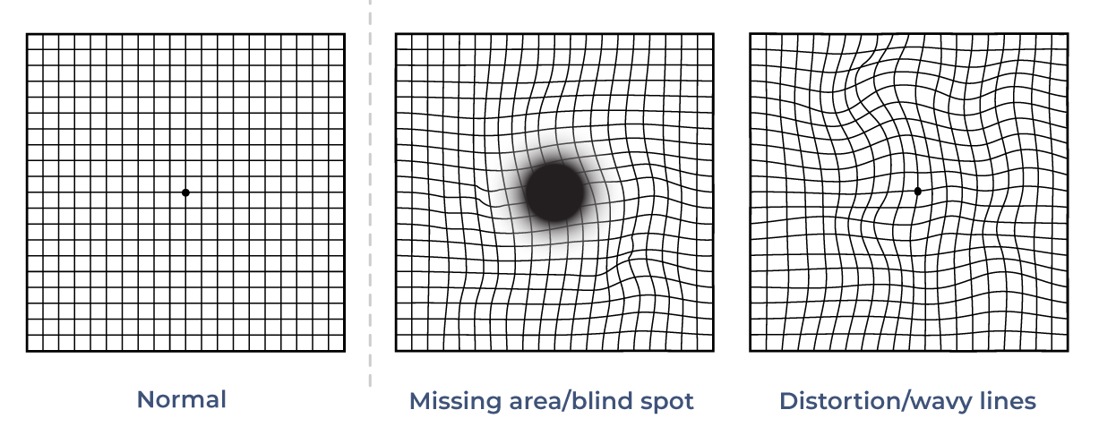 Tests for macular degeneration: Amsler grids and more